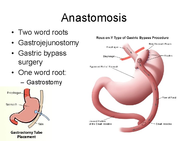 Anastomosis • Two word roots • Gastrojejunostomy • Gastric bypass surgery • One word