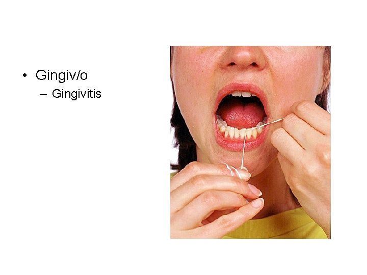  • Gingiv/o – Gingivitis 