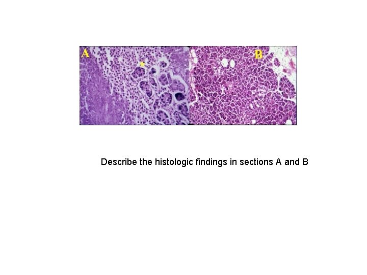 Pancreas Pathology Lab Case 2 47 yearold alcoholic