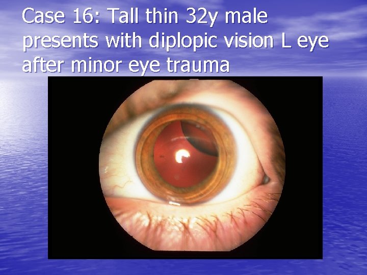 Case 16: Tall thin 32 y male presents with diplopic vision L eye after