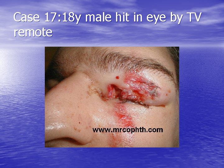 Case 17: 18 y male hit in eye by TV remote 