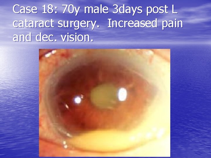 Case 18: 70 y male 3 days post L cataract surgery. Increased pain and