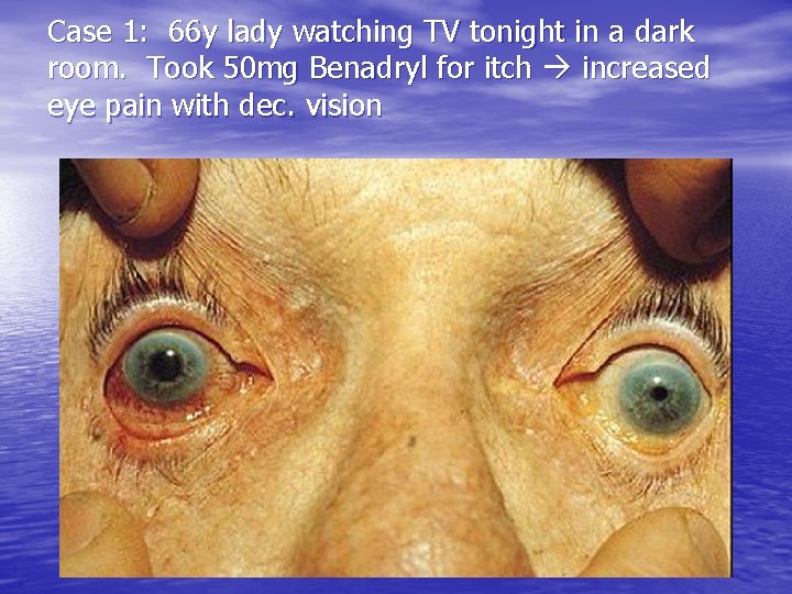 Case 1: 66 y lady watching TV tonight in a dark room. Took 50