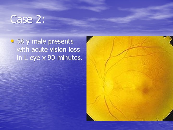 Case 2: • 58 y male presents with acute vision loss in L eye