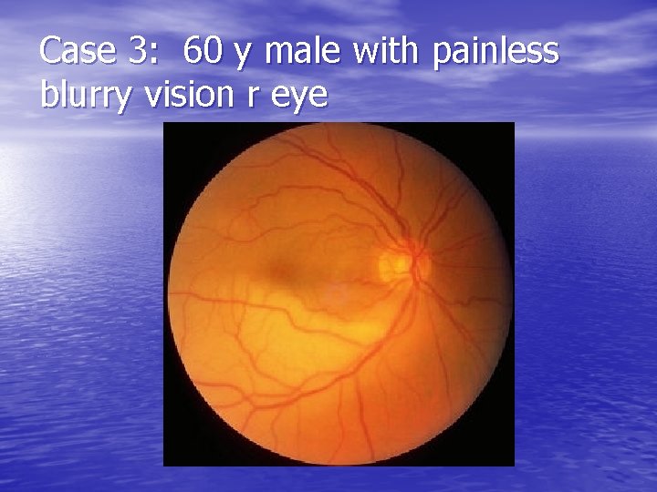 Case 3: 60 y male with painless blurry vision r eye 