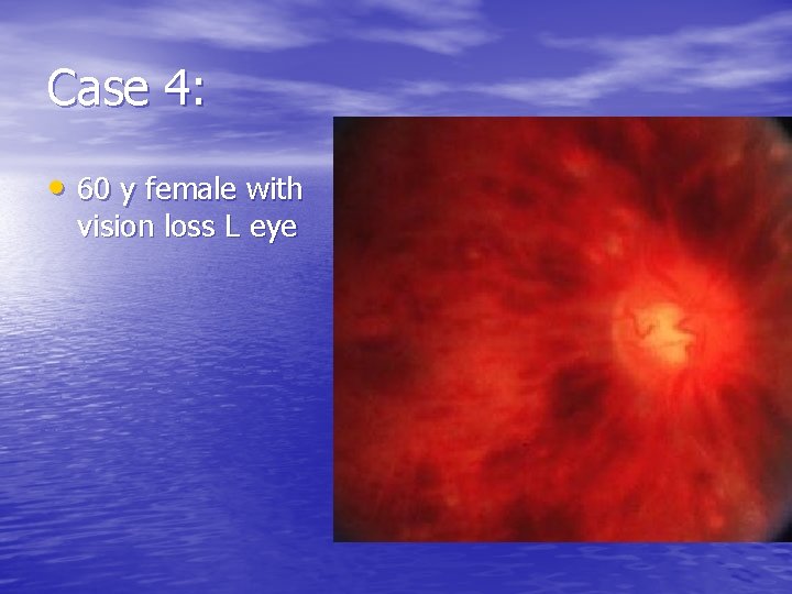 Case 4: • 60 y female with vision loss L eye 