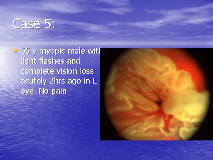 Case 5: • 55 y myopic male with light flashes and complete vision loss