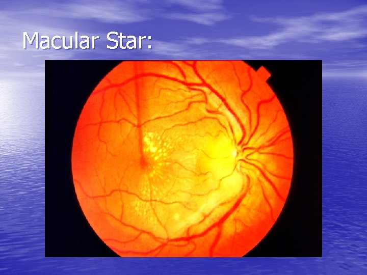 Macular Star: 