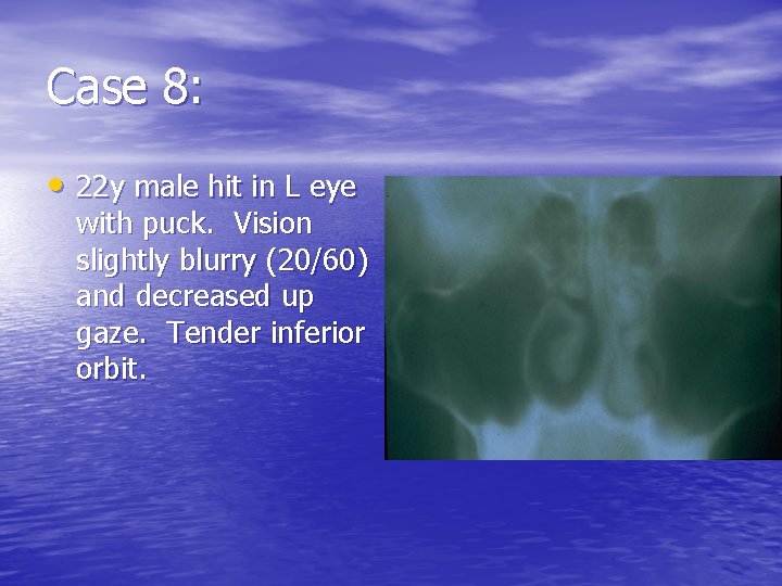 Case 8: • 22 y male hit in L eye with puck. Vision slightly