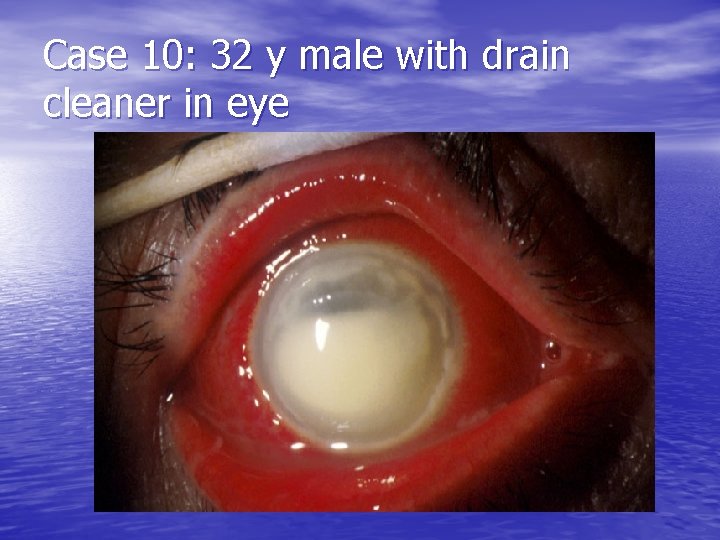 Case 10: 32 y male with drain cleaner in eye 