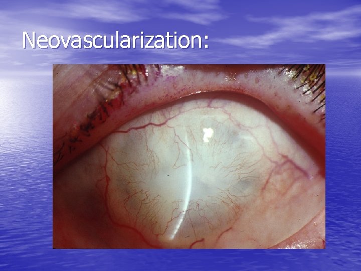 Neovascularization: 