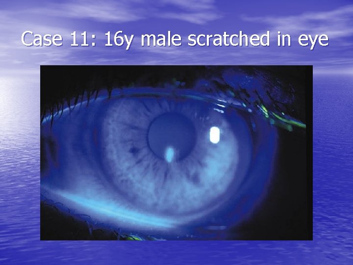 Case 11: 16 y male scratched in eye 