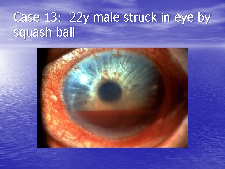 Case 13: 22 y male struck in eye by squash ball 