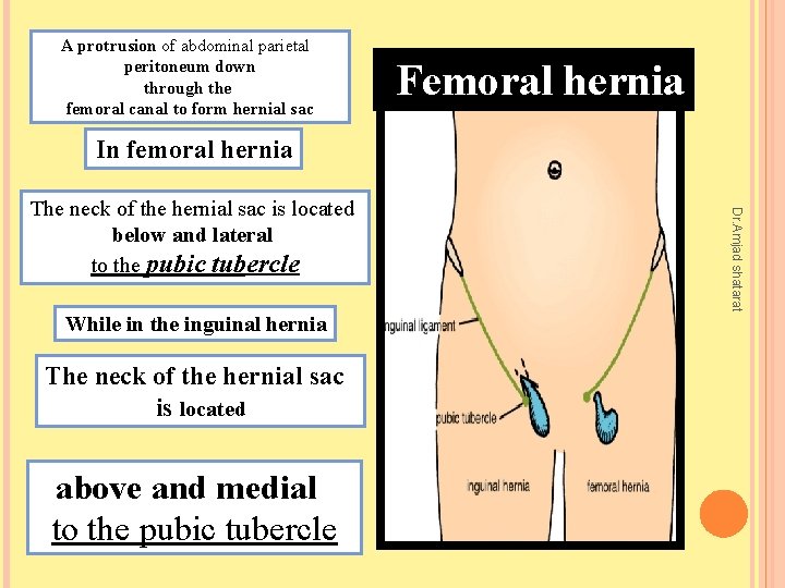 A protrusion of abdominal parietal peritoneum down through the femoral canal to form hernial