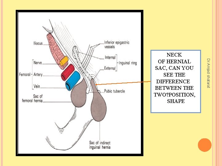 Dr. Amjad shatarat NECK OF HERNIAL SAC, CAN YOU SEE THE DIFFERENCE BETWEEN THE