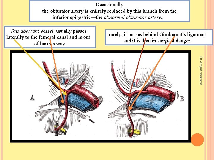 Occasionally the obturator artery is entirely replaced by this branch from the inferior epigastric—the