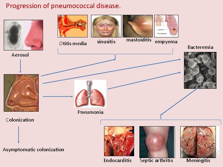 Progression of pneumococcal disease. Otitis media sinusitis mastoiditis empyema Bacteremia Aerosol Pneumonia Colonization Asymptomatic