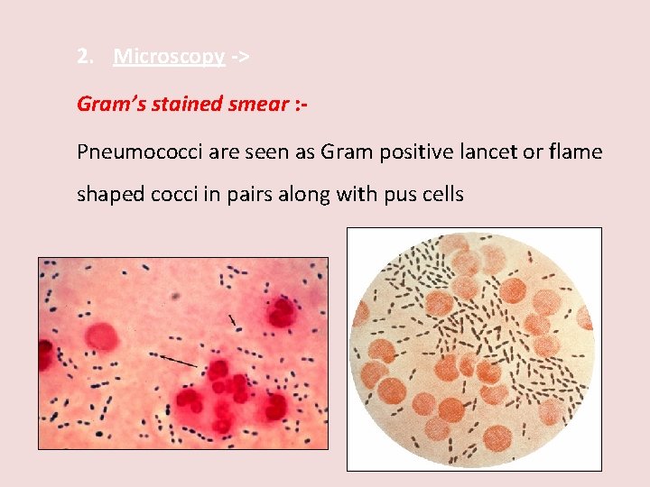 2. Microscopy -> Gram’s stained smear : Pneumococci are seen as Gram positive lancet