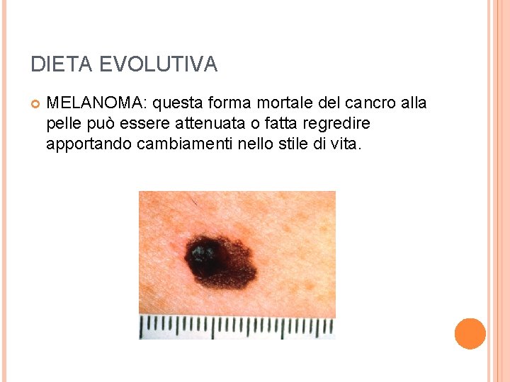 DIETA EVOLUTIVA MELANOMA: questa forma mortale del cancro alla pelle può essere attenuata o