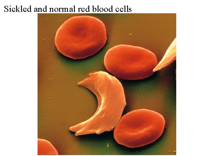 Sickled and normal red blood cells 