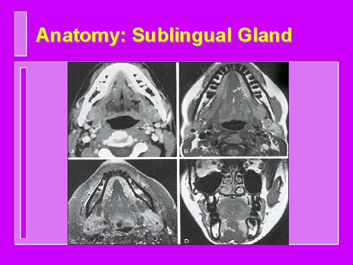 Anatomy: Sublingual Gland 