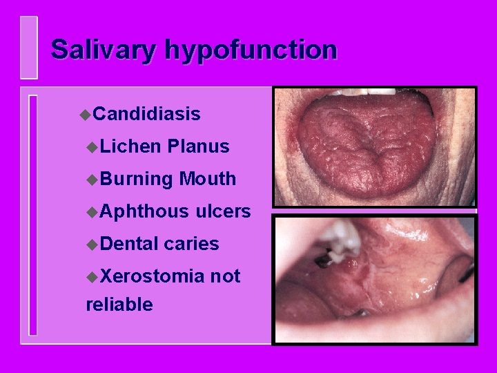 Salivary hypofunction u. Candidiasis u. Lichen Planus u. Burning Mouth u. Aphthous u. Dental