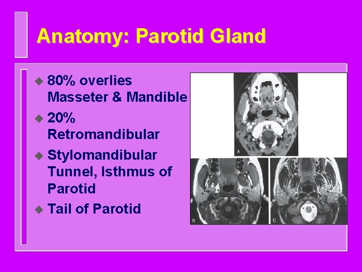 Anatomy: Parotid Gland u 80% overlies Masseter & Mandible u 20% Retromandibular u Stylomandibular