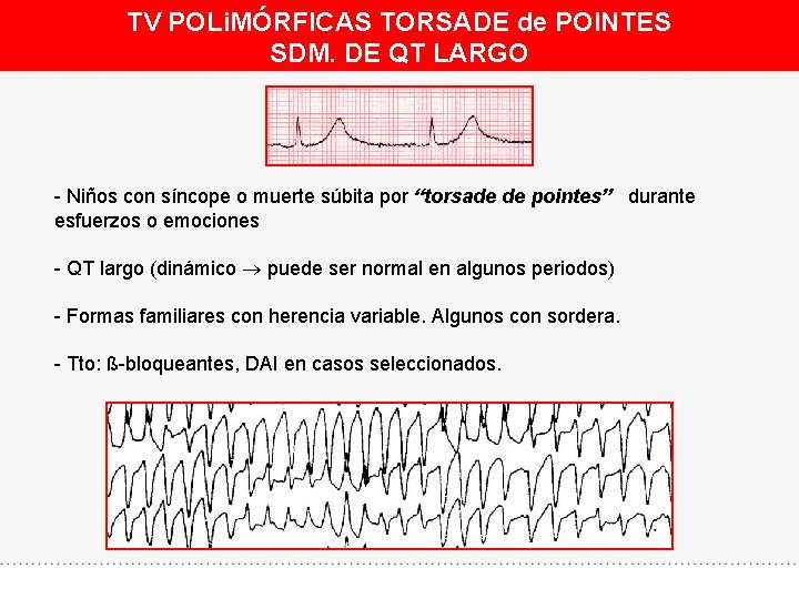TV POLi. MÓRFICAS TORSADE de POINTES SDM. DE QT LARGO - Niños con síncope