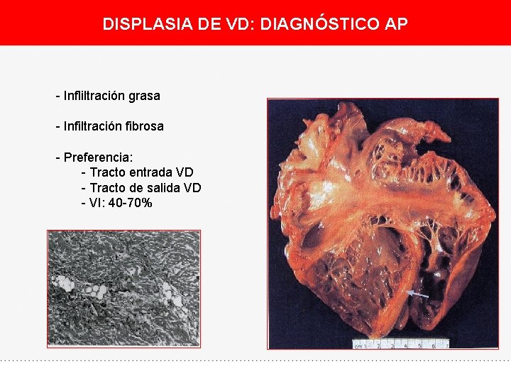 DISPLASIA DE VD: DIAGNÓSTICO AP - Infliltración grasa - Infiltración fibrosa - Preferencia: -