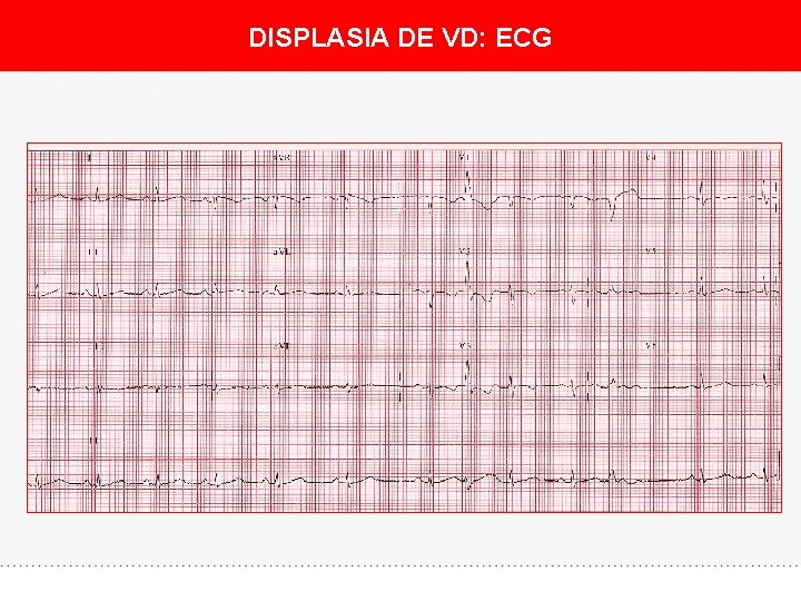 DISPLASIA DE VD: ECG 