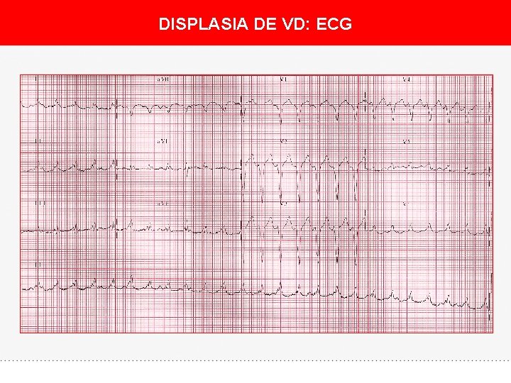 DISPLASIA DE VD: ECG 