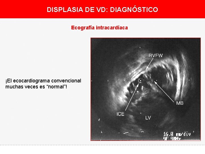 DISPLASIA DE VD: DIAGNÓSTICO Ecografía intracardíaca ¡El ecocardiograma convencional muchas veces es “normal”! 