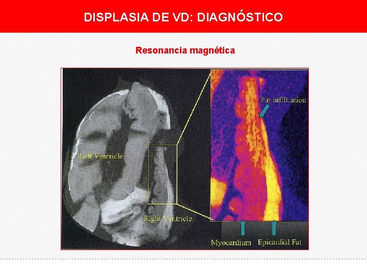 DISPLASIA DE VD: DIAGNÓSTICO Resonancia magnética 