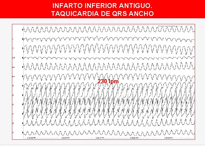 INFARTO INFERIOR ANTIGUO. TAQUICARDIA DE QRS ANCHO 230 lpm 