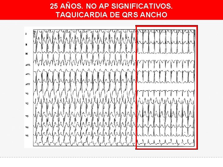 25 AÑOS. NO AP SIGNIFICATIVOS. TAQUICARDIA DE QRS ANCHO 