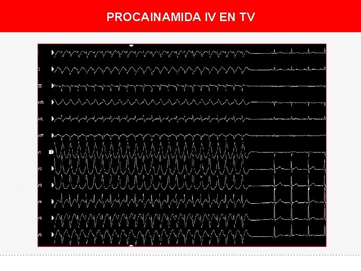 PROCAINAMIDA IV EN TV 