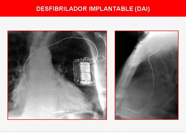 DESFIBRILADOR IMPLANTABLE (DAI) 