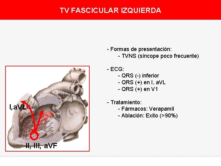 TV FASCICULAR IZQUIERDA - Formas de presentación: - TVNS (síncope poco frecuente) - ECG: