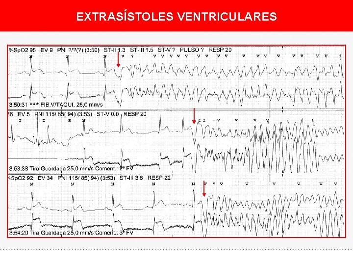 EXTRASÍSTOLES VENTRICULARES 