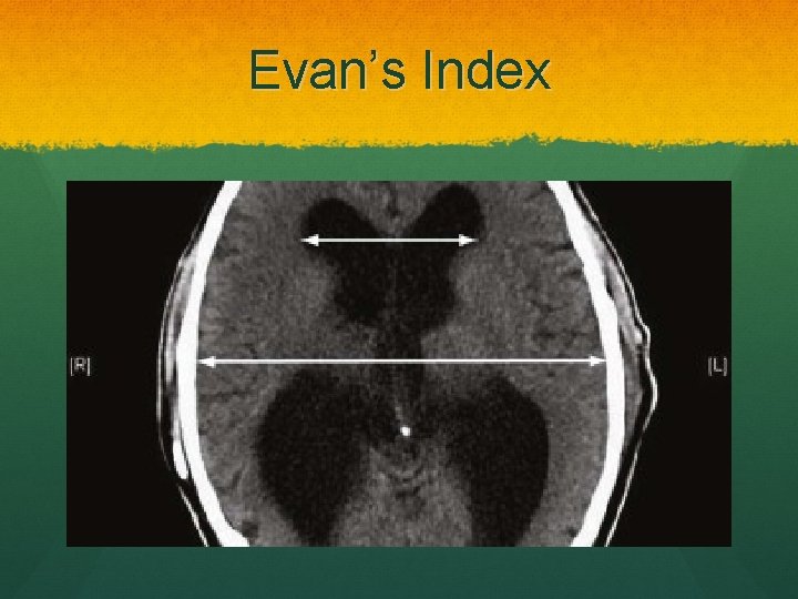 Evan’s Index 