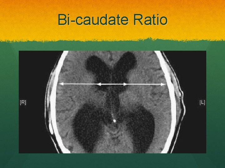 Bi-caudate Ratio 