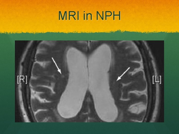 MRI in NPH 