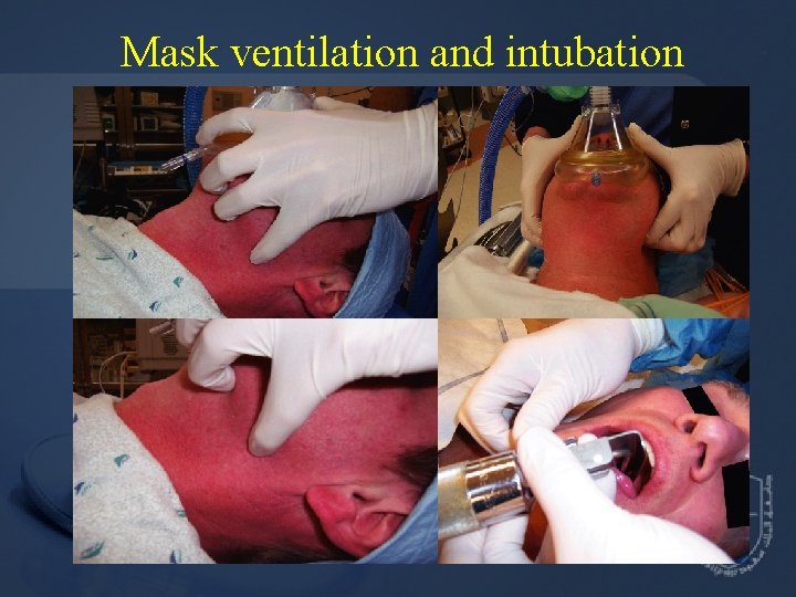 Mask ventilation and intubation 
