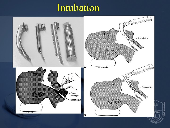 Intubation 