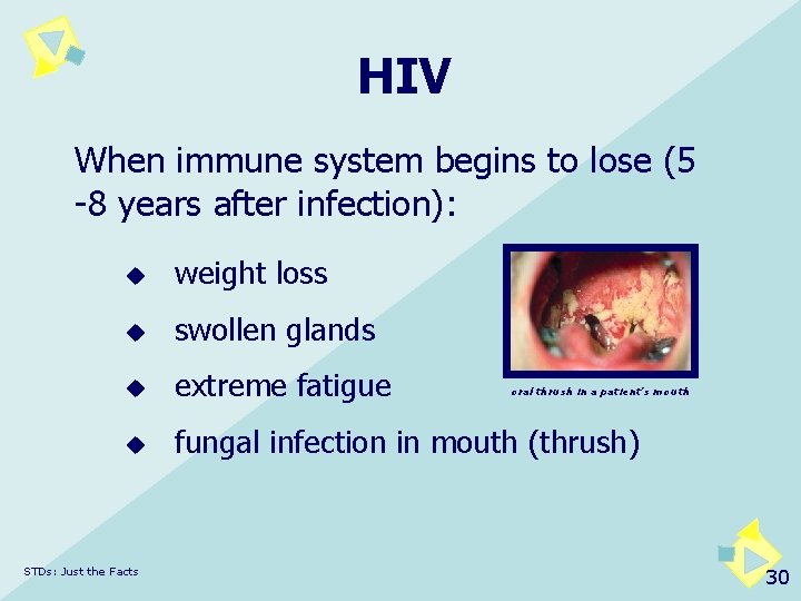 HIV When immune system begins to lose (5 -8 years after infection): u weight