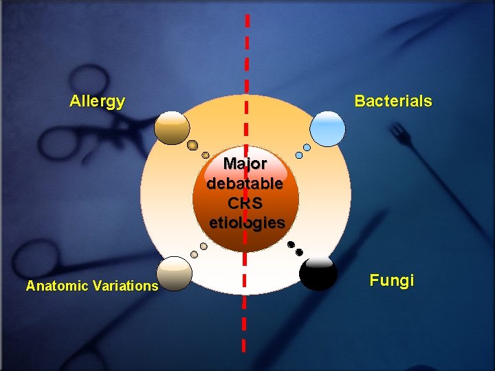 Allergy Bacterials Major debatable CRS etiologies Anatomic Variations Fungi 