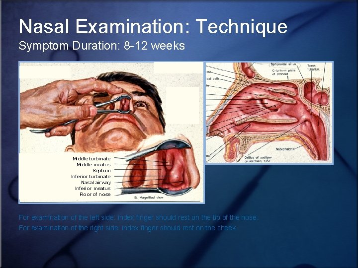 Nasal Examination: Technique Symptom Duration: 8 -12 weeks Middle turbinate Middle meatus Septum Inferior