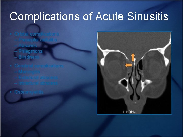 Complications of Acute Sinusitis • Orbital complications – Preseptal cellulitis – Abscess – Phlegmona