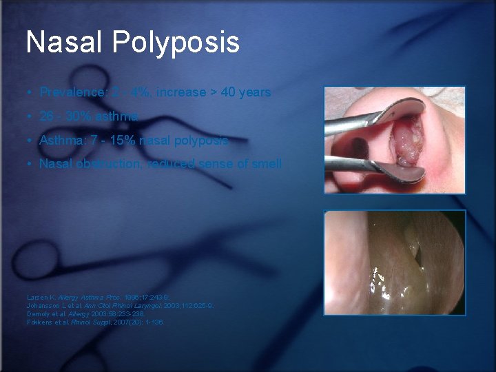Nasal Polyposis • Prevalence: 2 - 4%, increase > 40 years • 26 -
