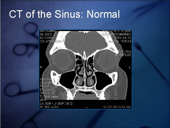 CT of the Sinus: Normal 